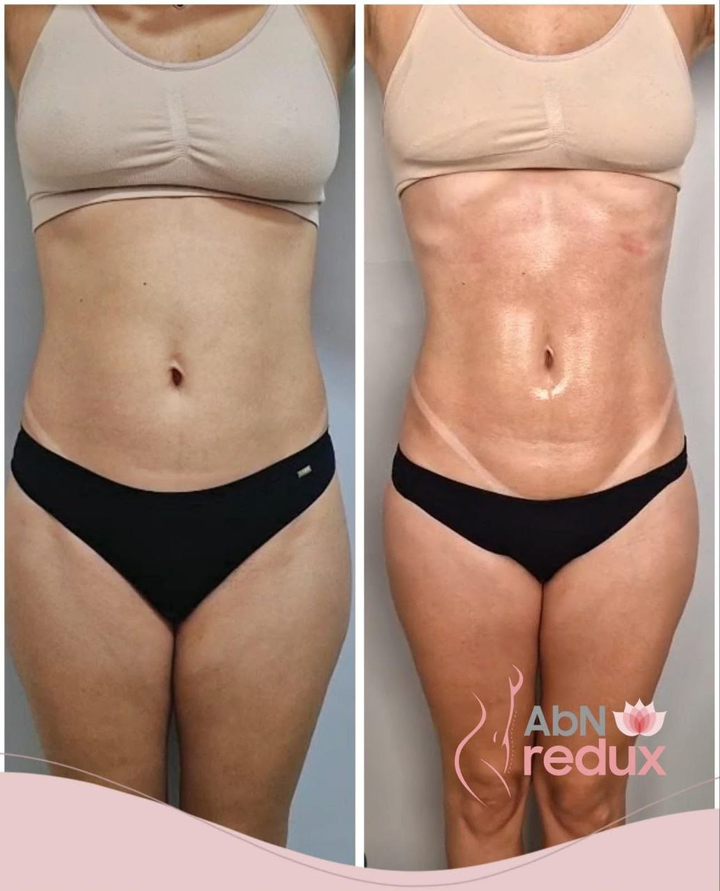 Comparativo de resultado corporal antes e depois
